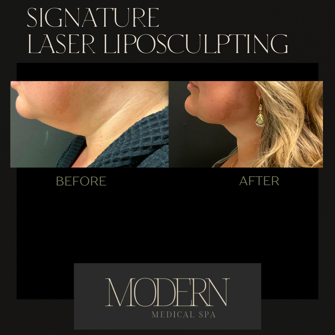 liposuction Before and After 5