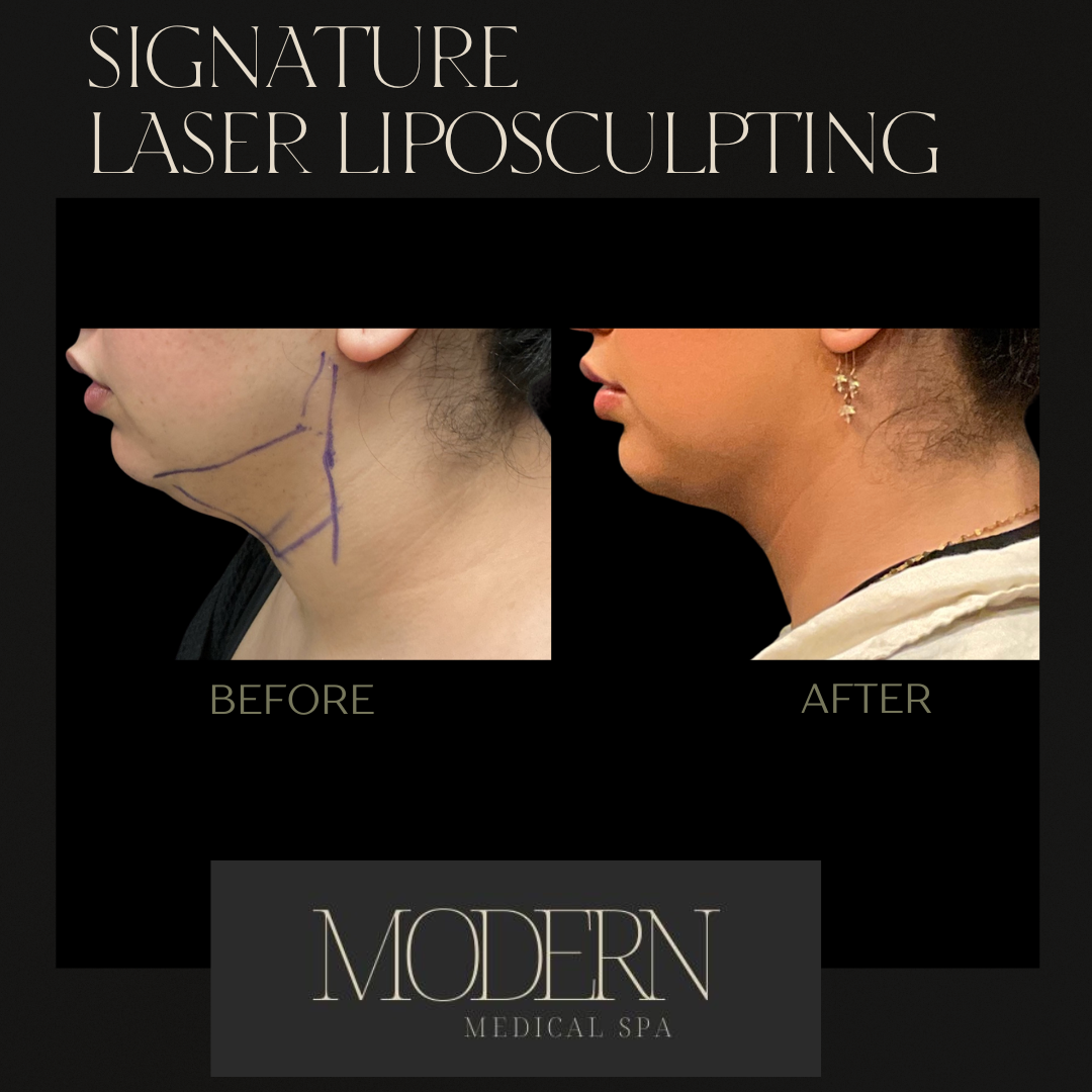 liposuction Before and After 4