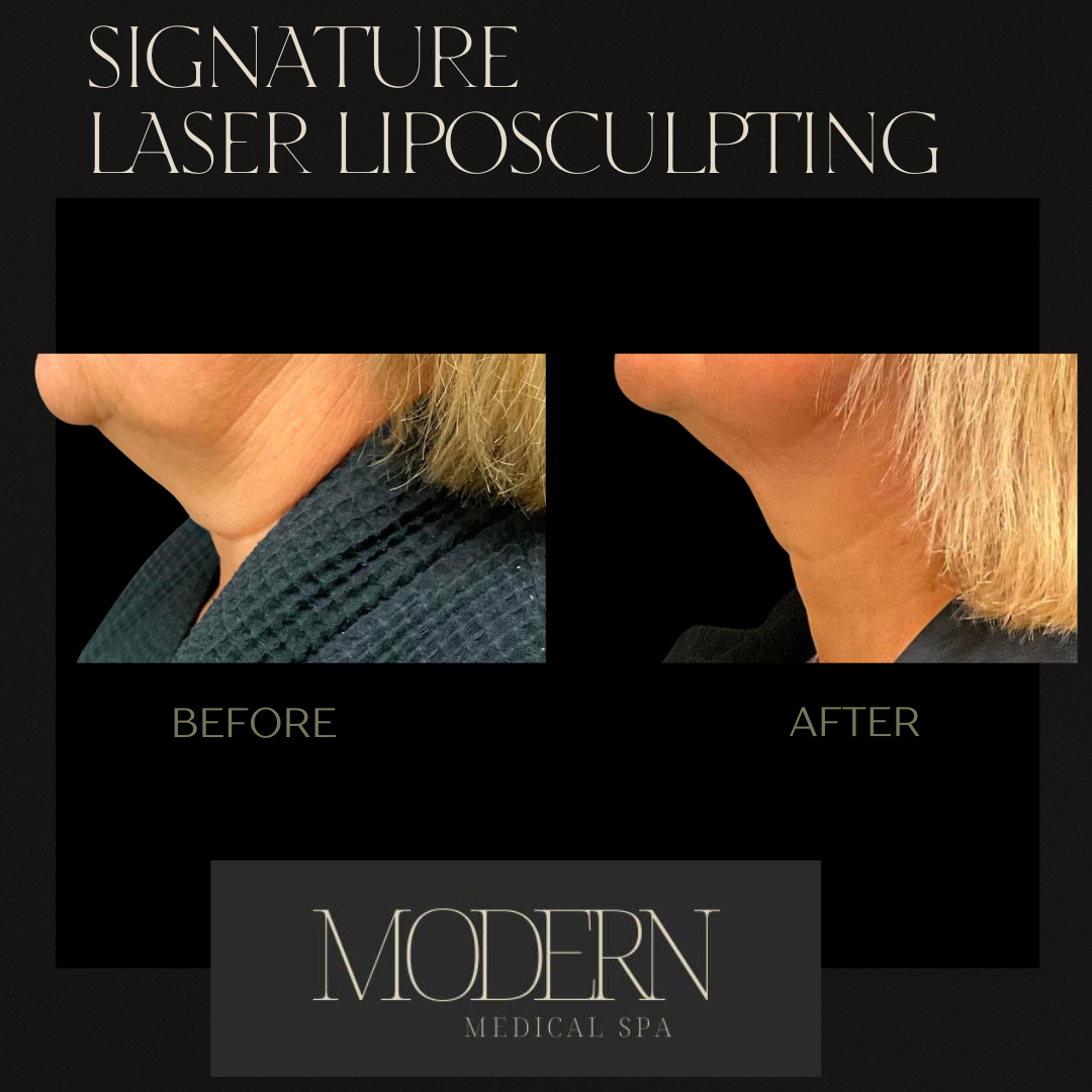 liposuction Before and After 2