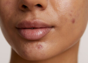 Fotona Active Acne Near Florence + Hartsville SC