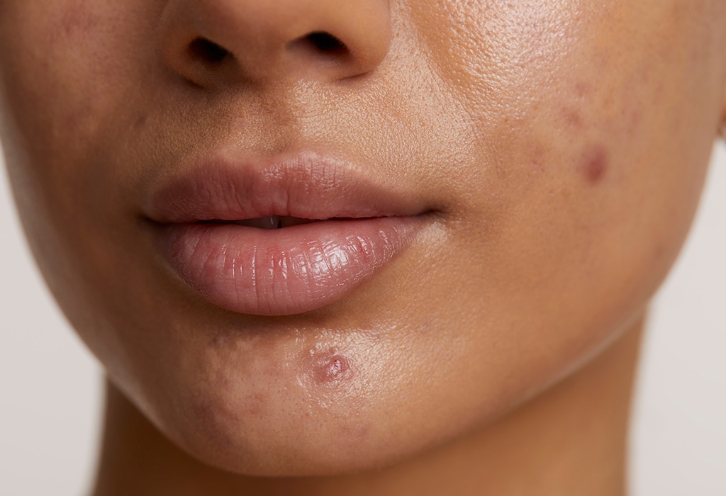 Fotona Active Acne Near Florence + Hartsville SC Fotona Active Acne Near Florence + Hartsville SC