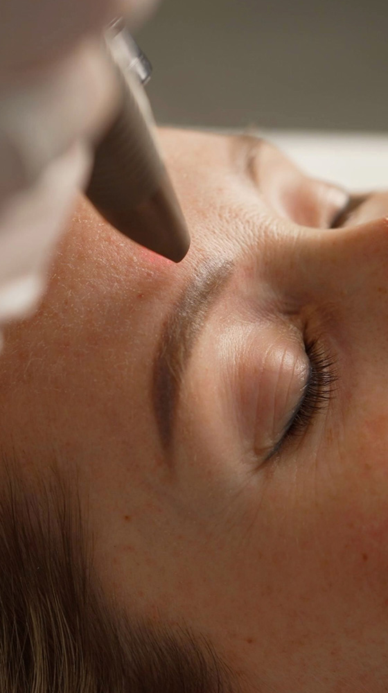 Fotona Active Acne in Florence SC Fotona Active Acne in Florence SC