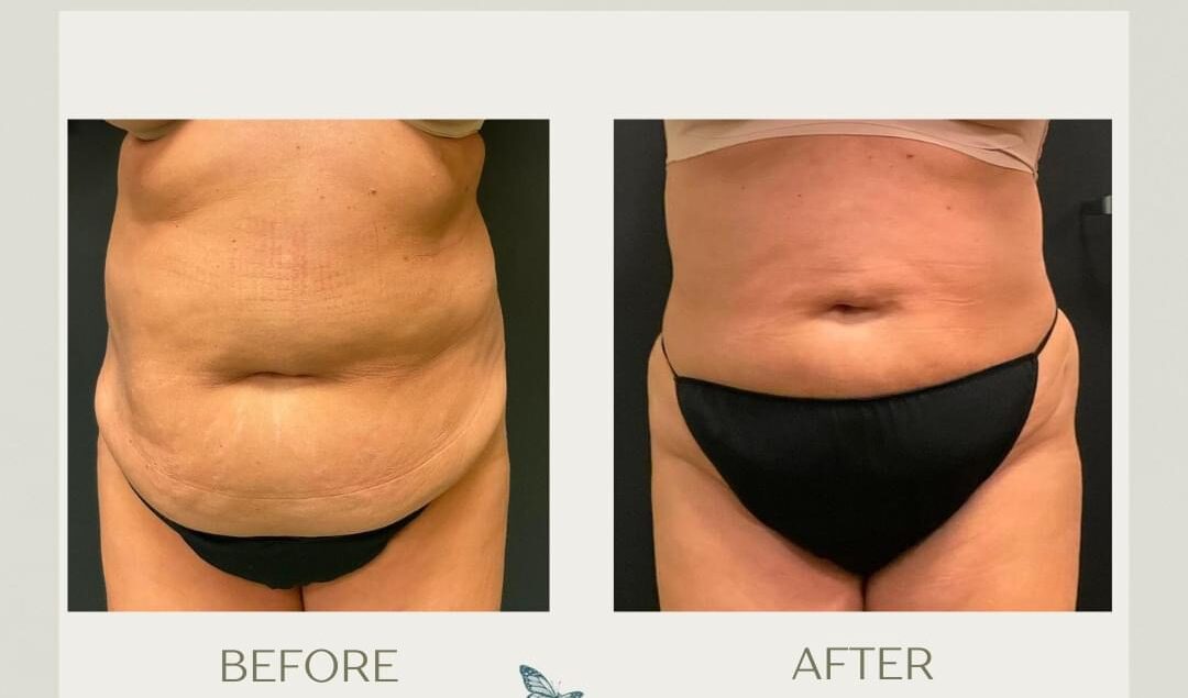 Liposuction
