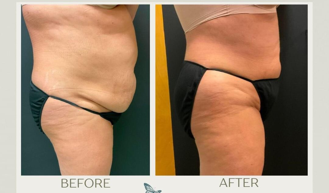 Liposuction near Florence