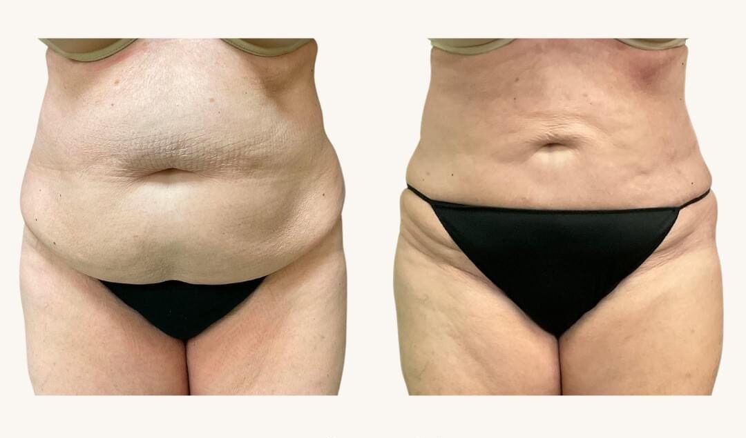 Liposuction near Hartsville