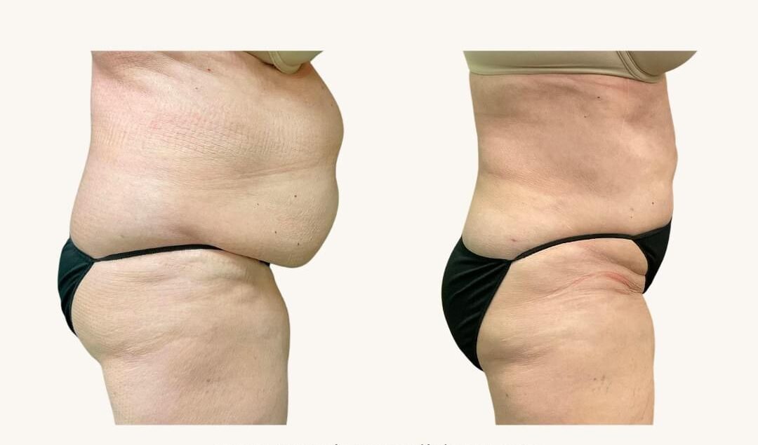 Liposuction
