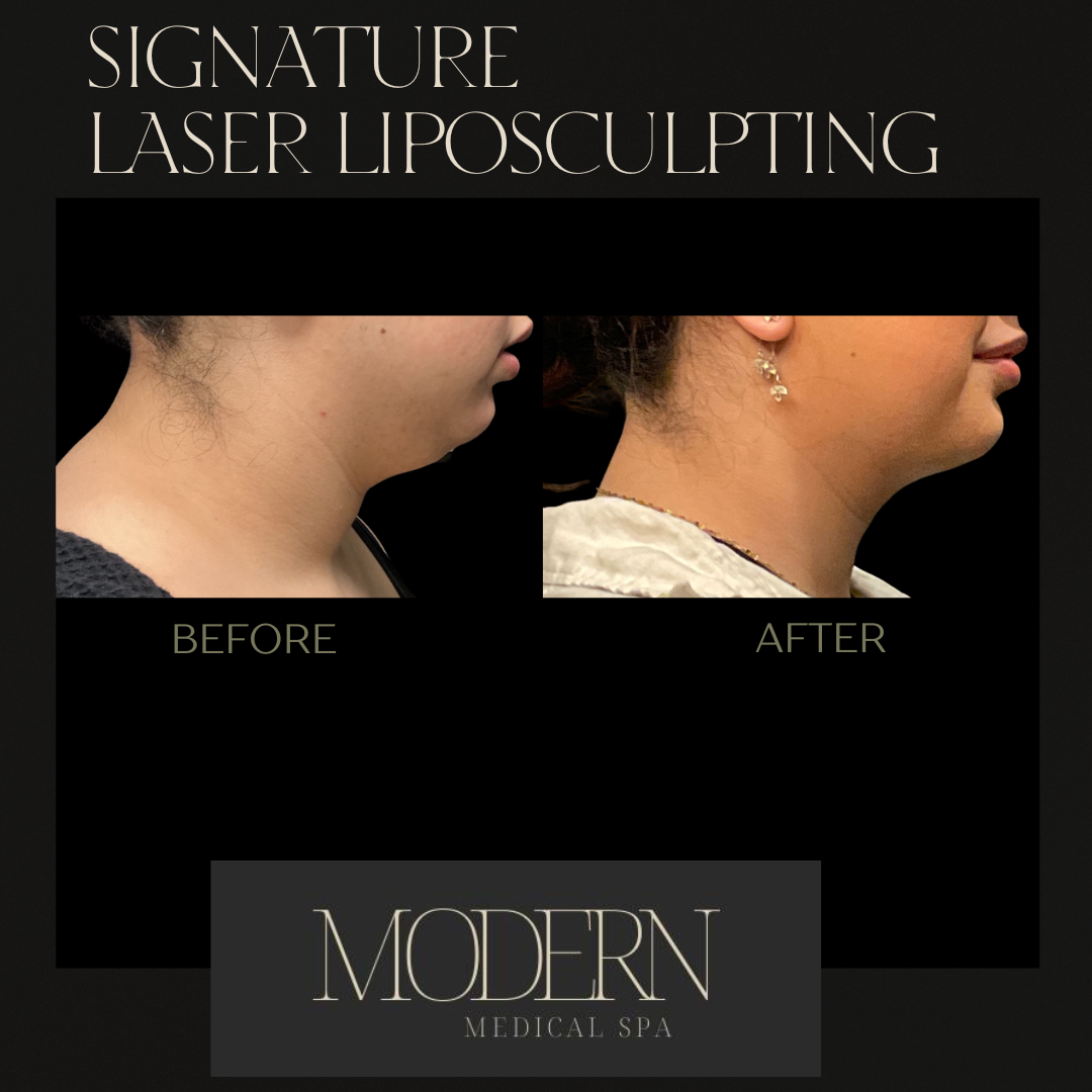 liposuction Before and After 3