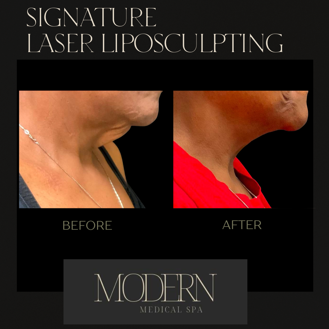 liposuction Before and After 1