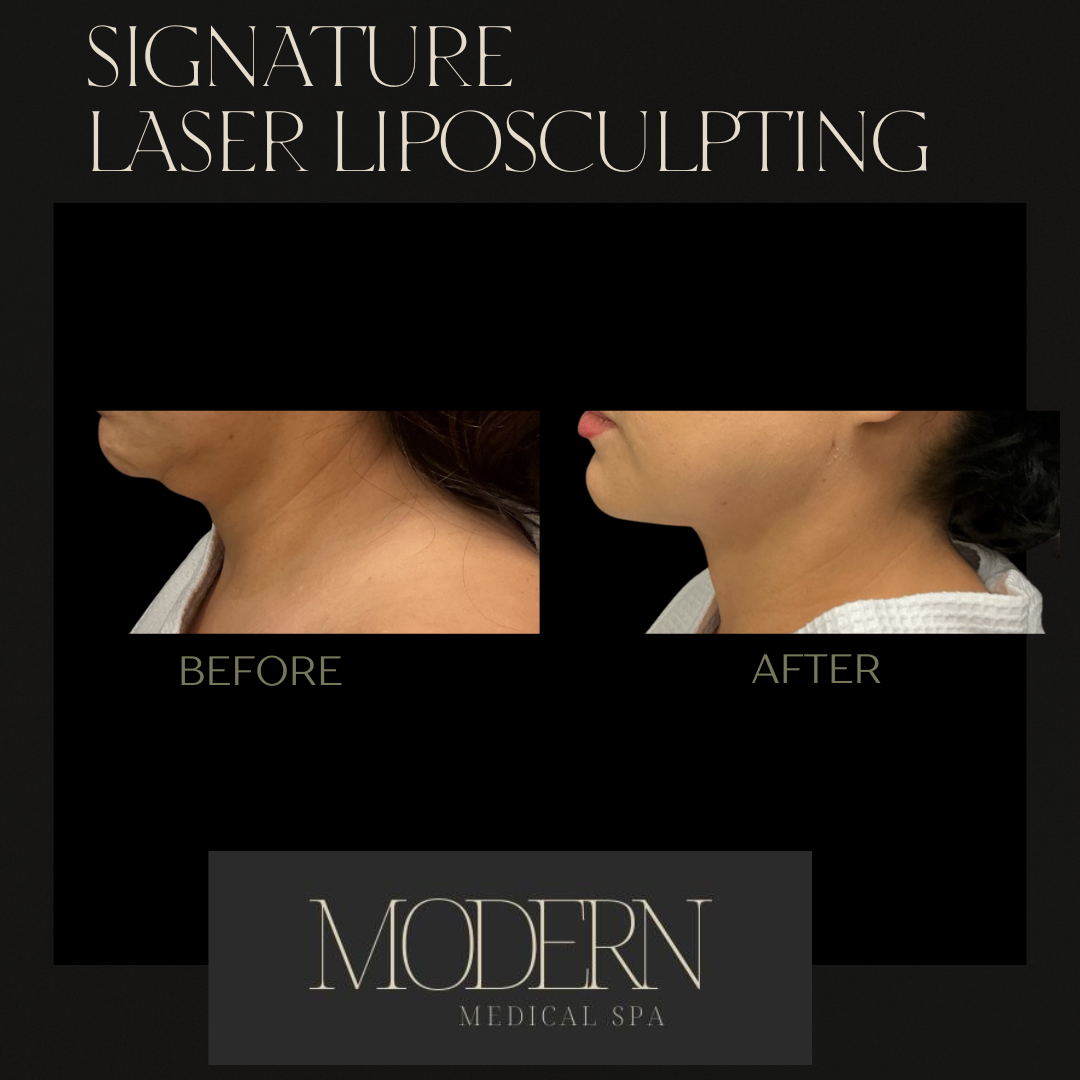 liposuction Before and After 6