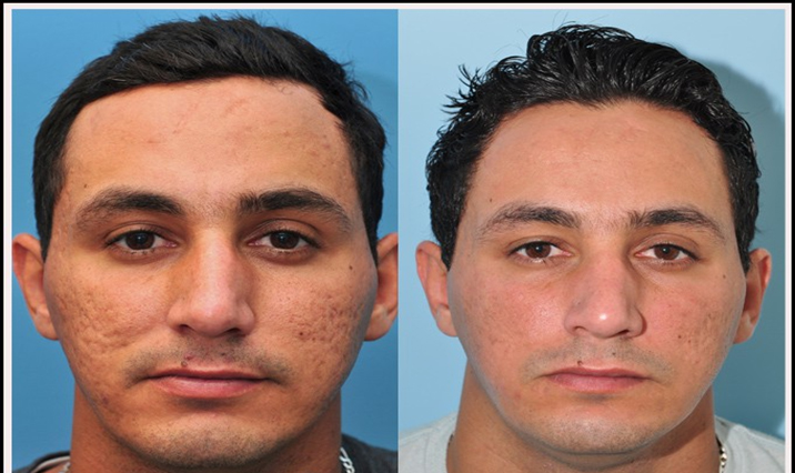 Laser Acne Scar Removal