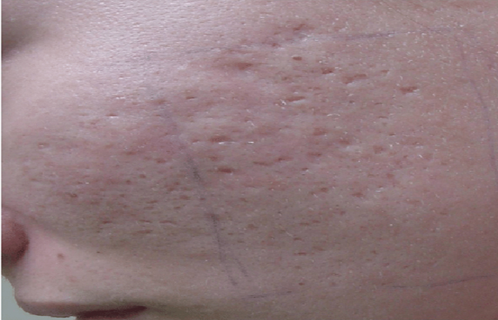 Laser Acne Scar Removal