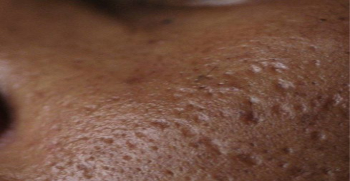 Laser Acne Scar Removal