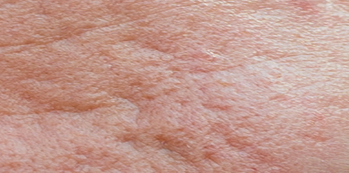 Laser Acne Scar Removal