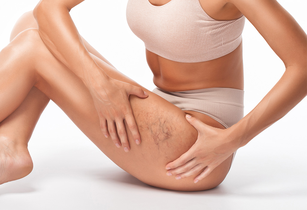 Spider Vein Therapy Near Florence + Hartsville SC Spider Vein Therapy Near Florence + Hartsville SC
