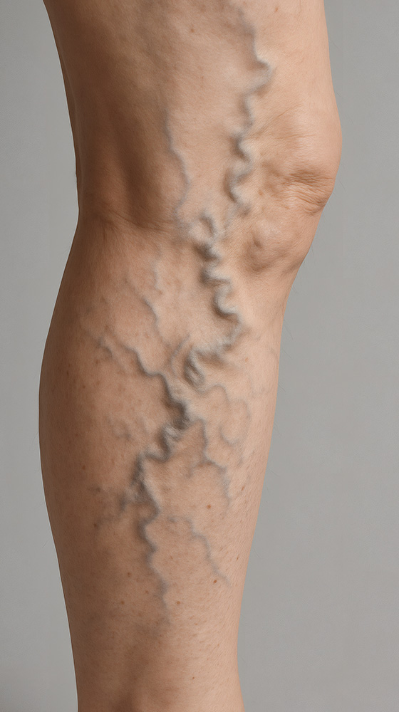 Spider Vein Therapy in Florence SC