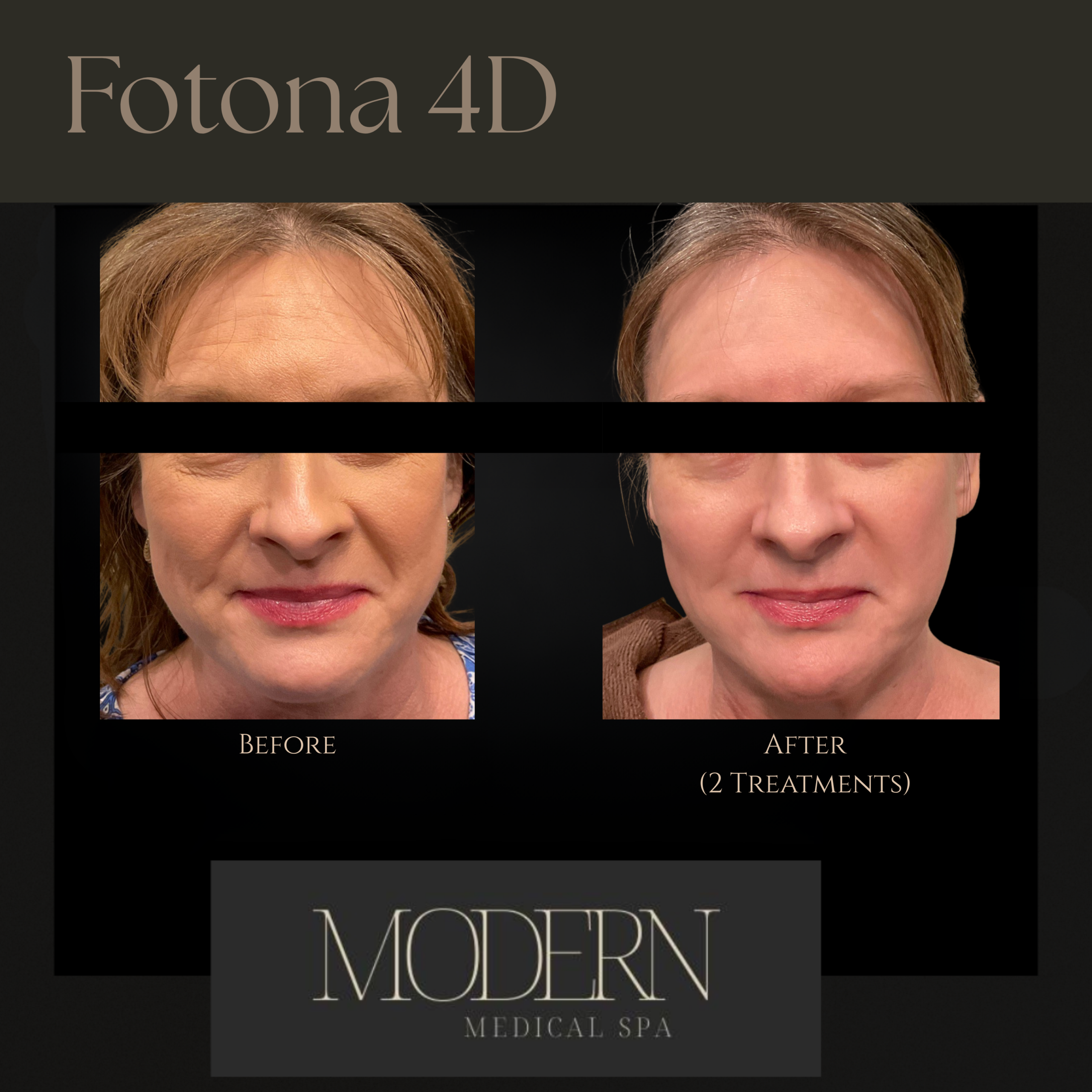 Fotona 4d before & After 1