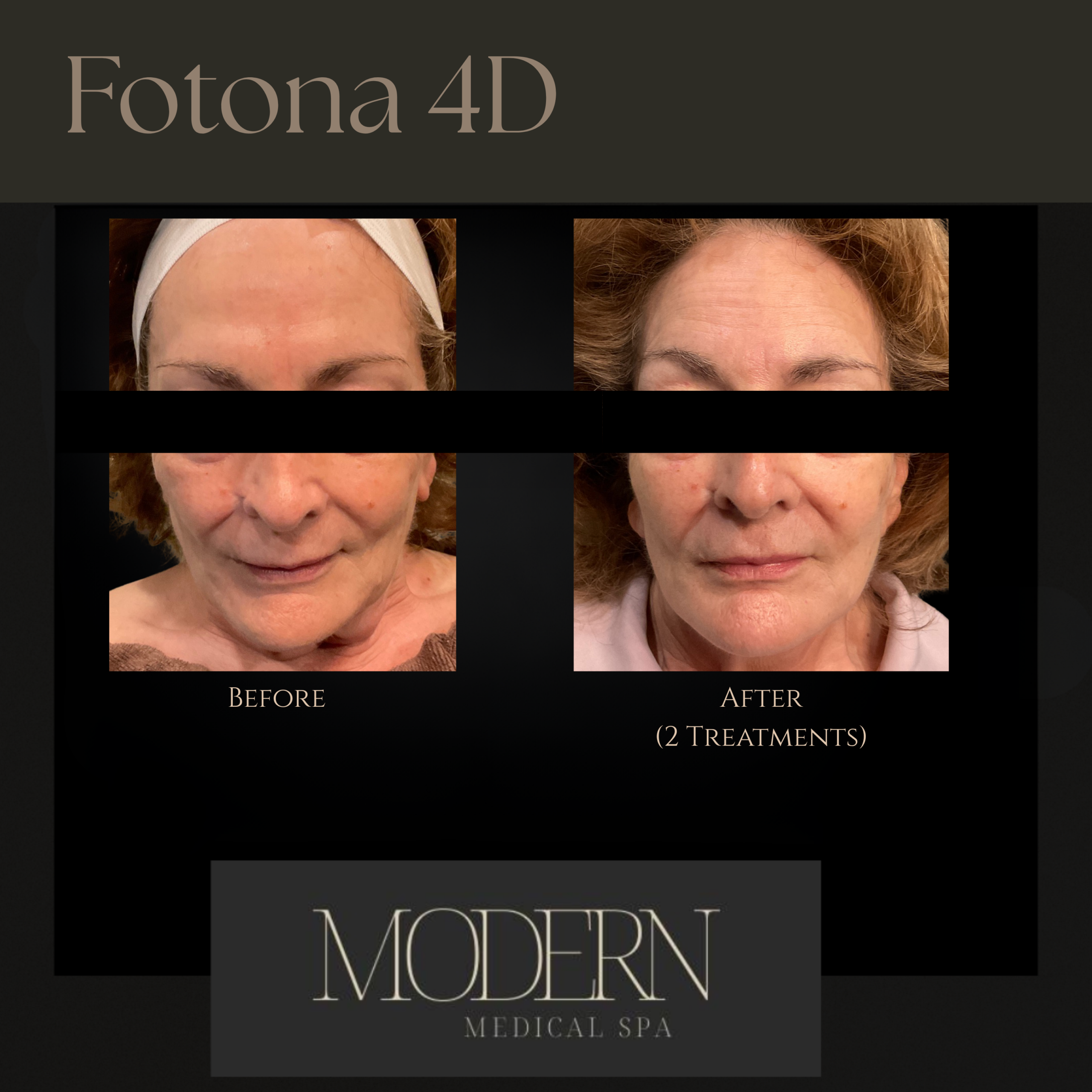 Fotona 4d before & After 2