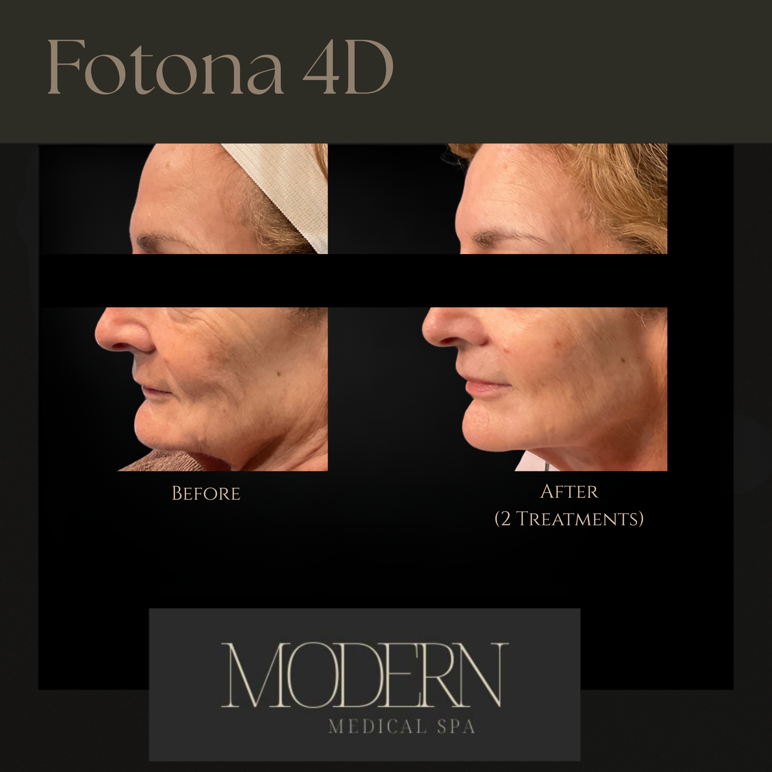 Fotona 4d before & After 3