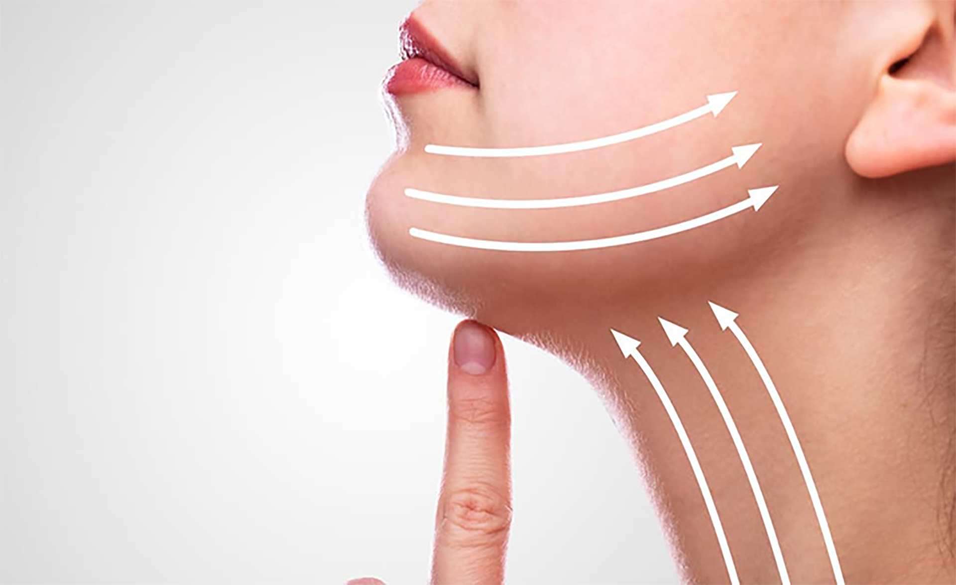 Fotona NeckTight