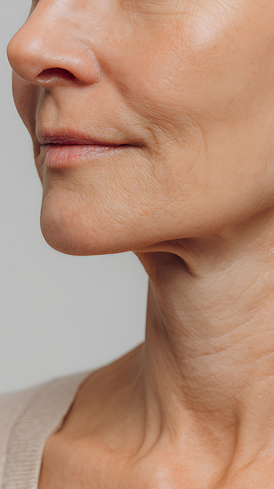 Fotona NeckTight in Florence SC