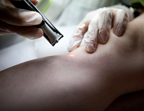 Laser Spider Vein Removal