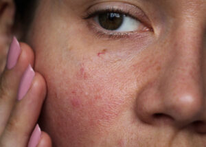 Fotona Rosacea Therapy Near Florence + Hartsville SC