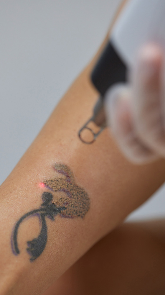 Tattoo Removal Tattoo Removal