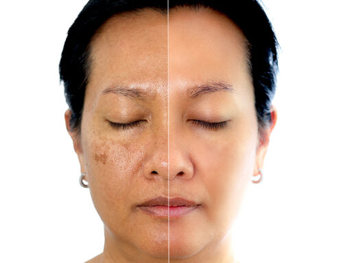 Sun/Brown Spot Treatment with Picosure