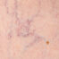 1064 Vein Laser
