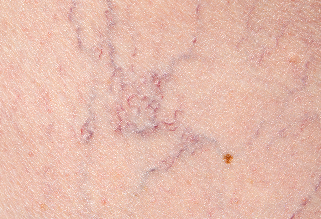 1064 Vein Laser 1064 Vein Laser