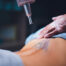 Picosure Tattoo Removal