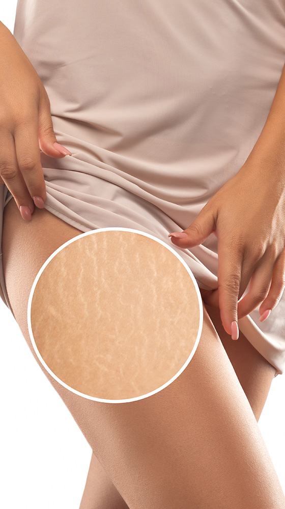 Stretch Mark Reduction