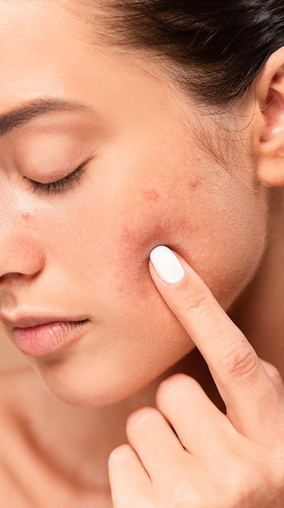 Acne Facial